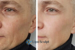 How to Fight Aging Symptoms 3 Fight Aging Symptoms Ayr With HIFU and Morpheus8 Today!