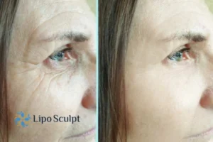 How to Fight Aging Symptoms 2 Do you want to Fight Aging Symptoms Ayr? Contact Lipo Sculpt today!