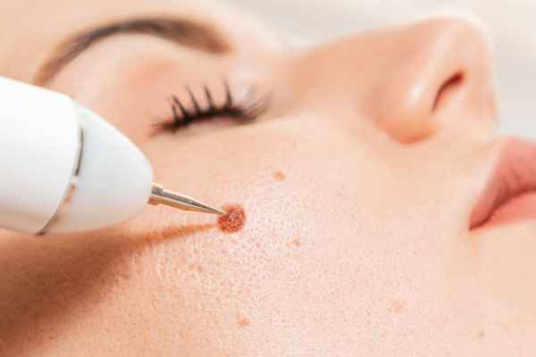 What actually happens during a CryoPen treatment Ayr?