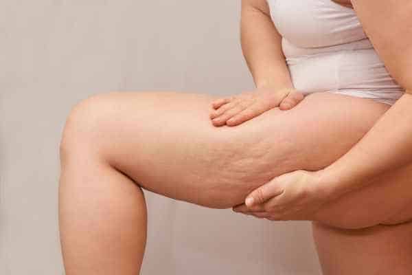 Find the best cellulite treatment Ayr for you!