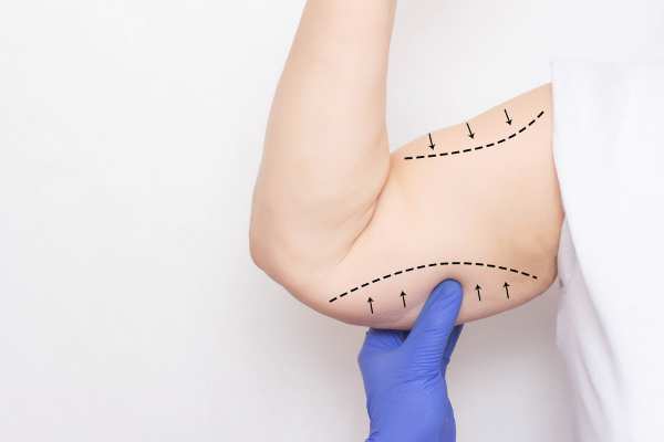 Arm toning treatment Ayr from lipo Sculpt!