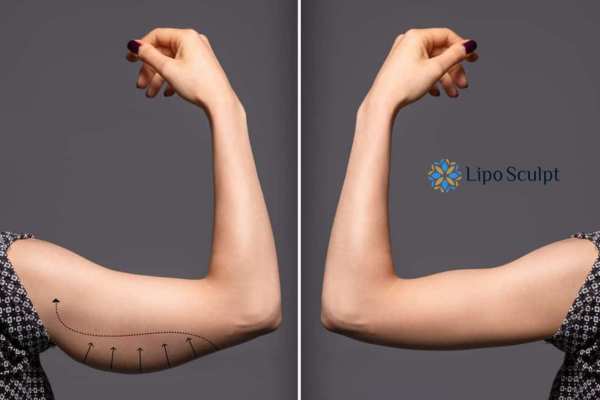 HIFU to reduce and tone sagging skin and fat on the arms from Lipo Sculpt Ayr