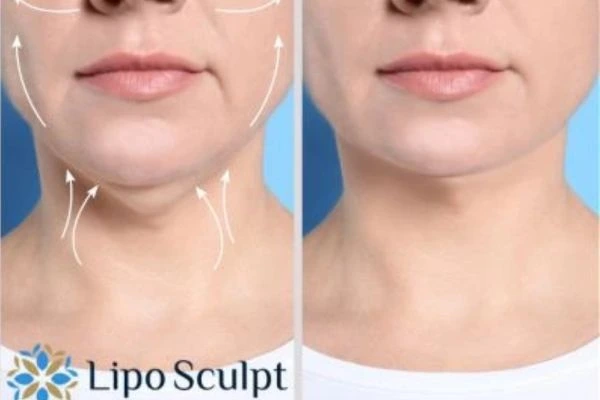 Book your Chin Reduction Treatment Ayr today! Call Lipo Sculpt NOW!