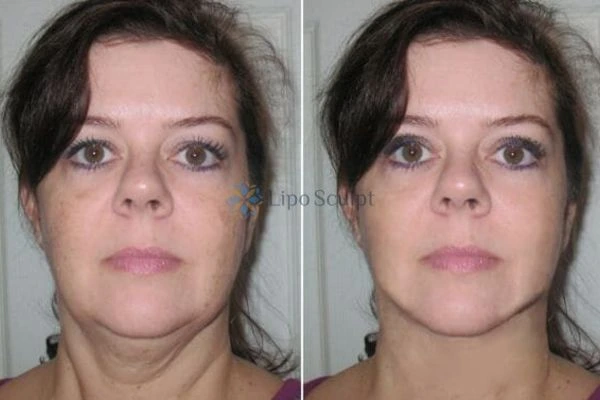 Chin Reduction Treatment Ayr - Aqualyx treatment