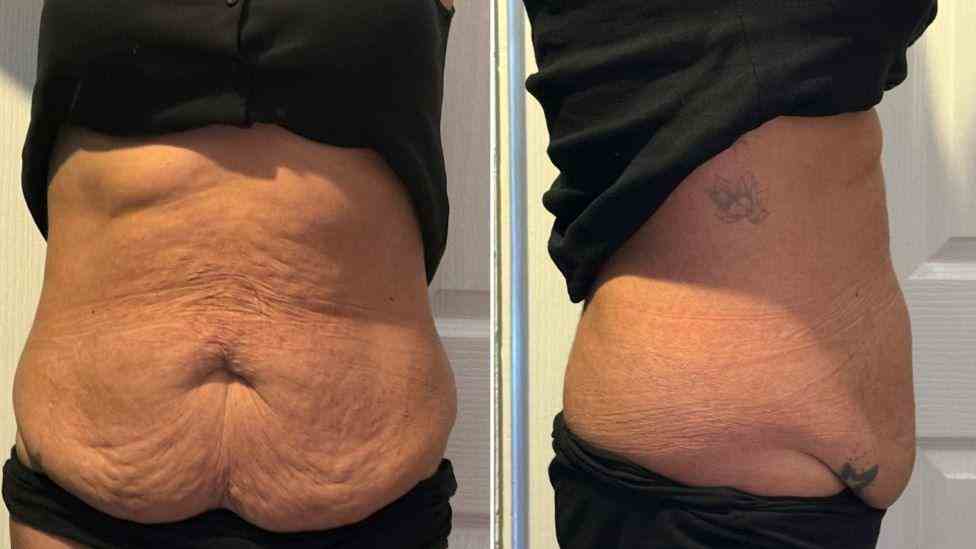Lost the Weight but Not the Loose Skin? What You Should Know 1 Is It Definitely Loose Skin Ayr?