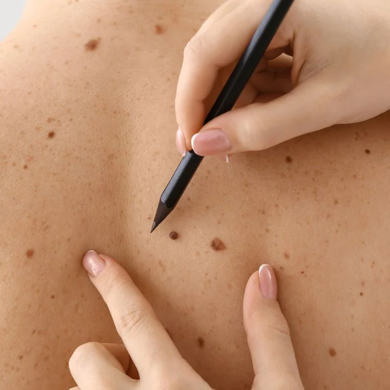 cryopen lesion removal treatment Ayr