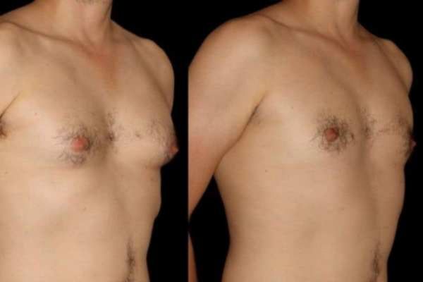 Before and After Cryolipolysis Fat Freezing Results Ayr