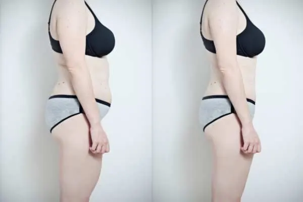 Before and After Cryolipolysis Fat Freezing Results Ayr