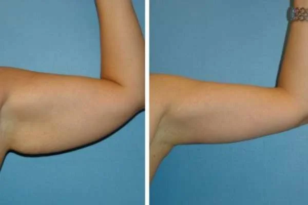 Before and After Cryolipolysis Fat Freezing Results Ayr